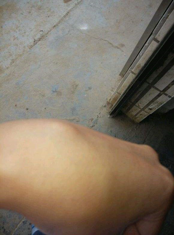 左手腕處手腕腱鞘炎