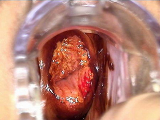 宮頸癌的早期症狀