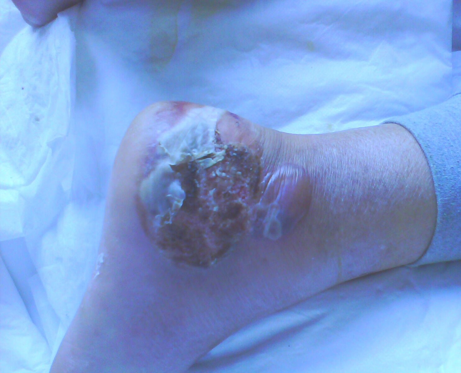 藥物治療糖尿病足高清