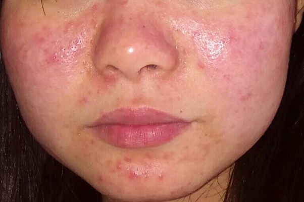 鼻子長蟎蟲症狀