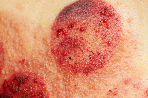 神經性皮炎的治療 (7) 