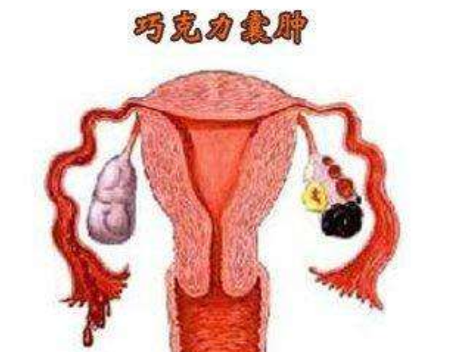 成人巧克力囊腫