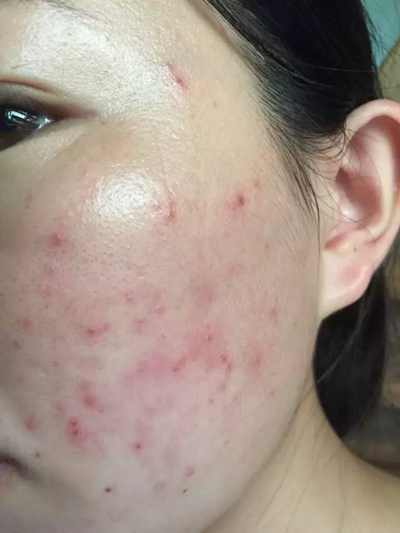 激素臉排毒症狀 (53) 