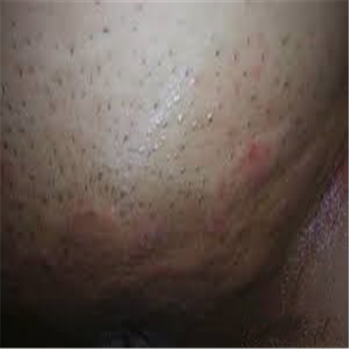 早期的外陰瘙癢