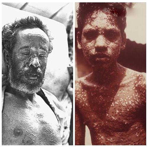 天花生化武器的