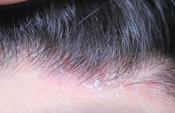 頭癬的症狀