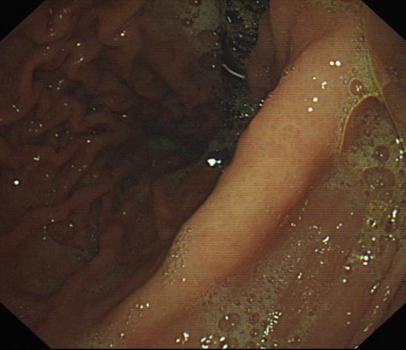 急性胃炎怎麼辦
