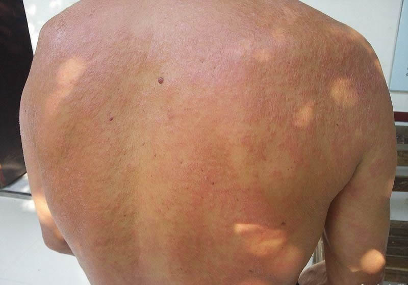 背部夏季皮炎