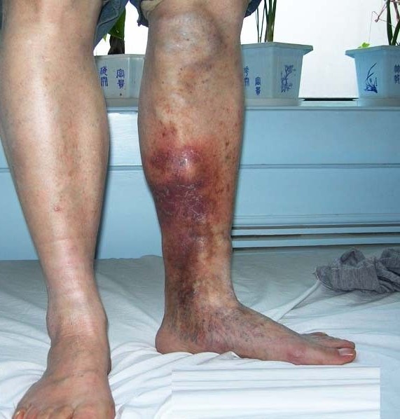 左小腿靜脈炎症狀