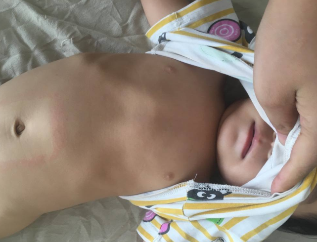 寶寶缺鈣雞胸圖 (8) 