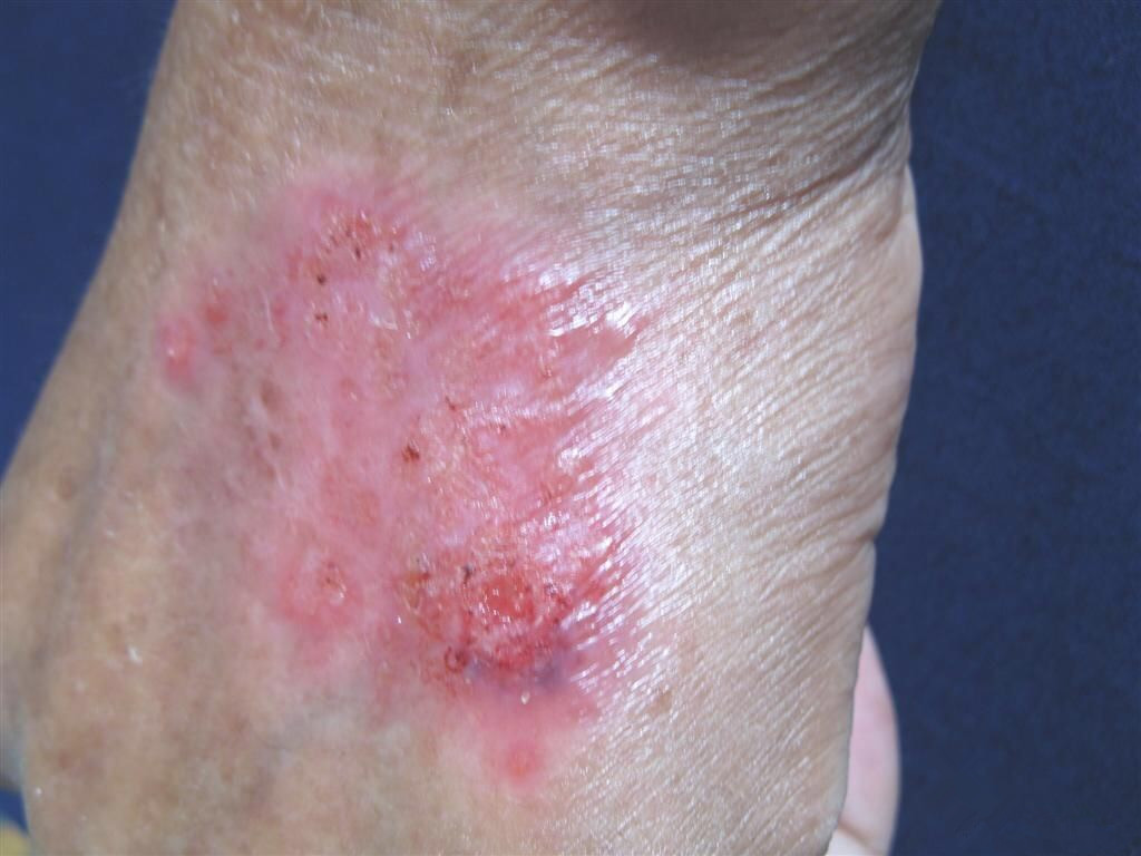 瘰病性初期皮膚結核病