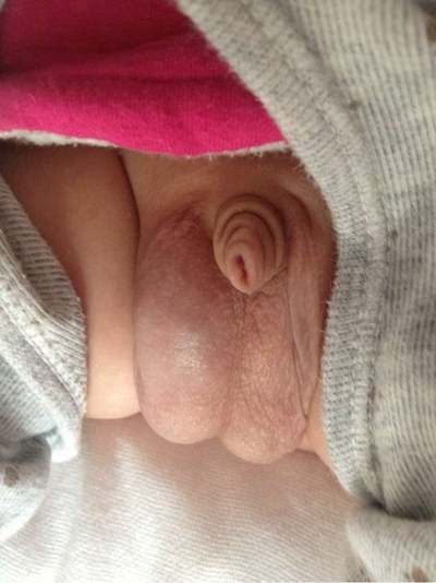 男寶寶疝氣的症狀