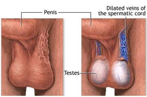 精索曲張睪丸下墜時