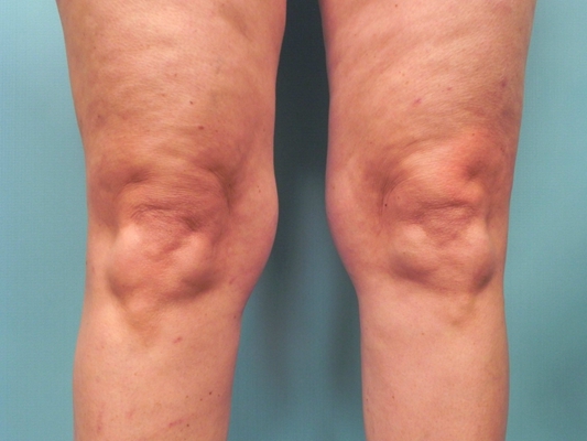 膝蓋骨質增生 (46) 