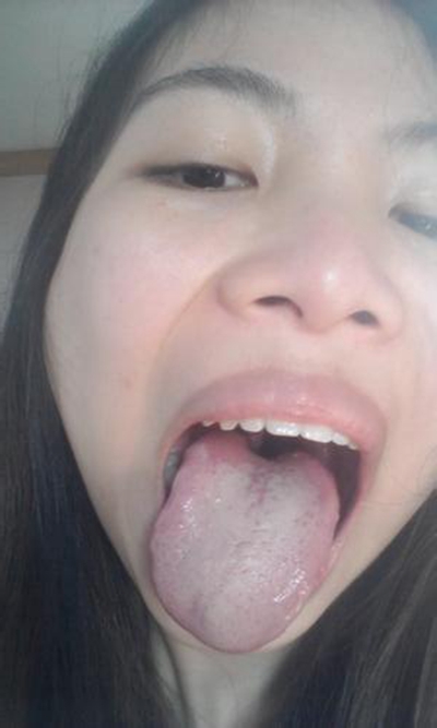 口腔念珠菌感染 (37) 