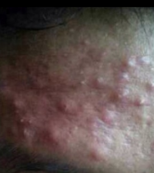 陰部皮囊炎症狀和