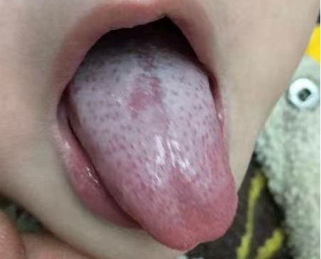 小兒猩紅熱症狀