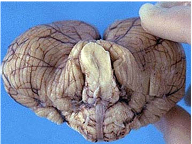 腦疝死亡小腦組織