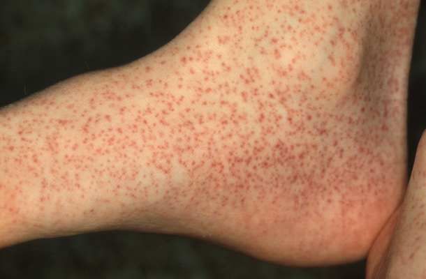 艾滋病紅疹症狀