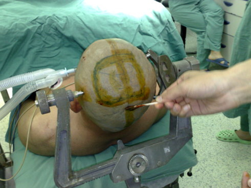 伽瑪刀腦膜瘤鈣化