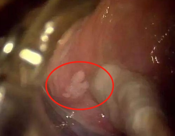 絨毛假性溼疣女