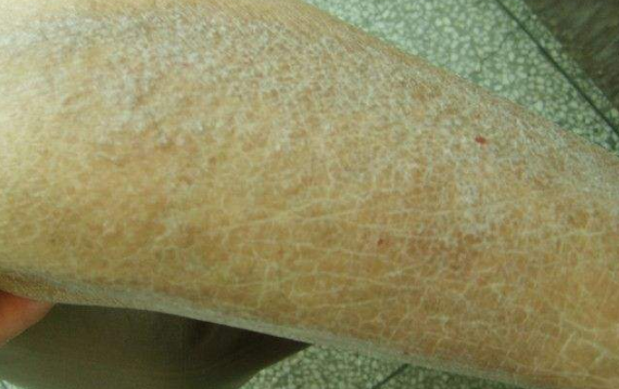 皮膚澱粉樣變 (8) 