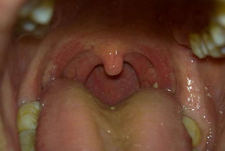 嚴重的急性咽炎的