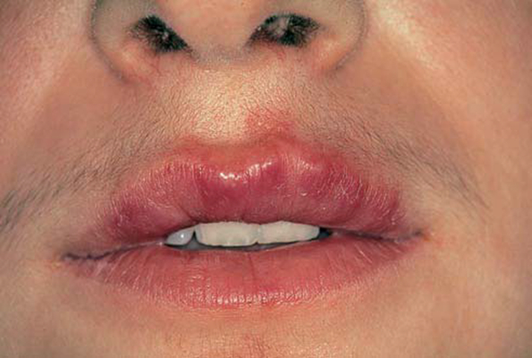 嘴上長皰疹 (49) 