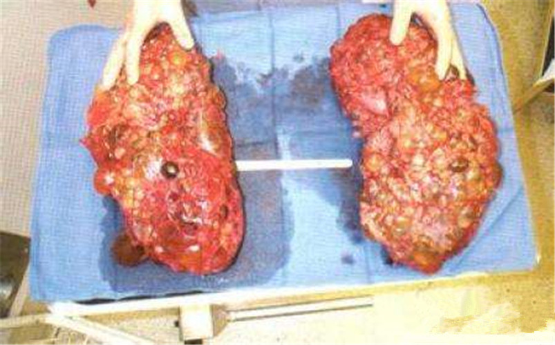 雙腎巨大腎囊腫