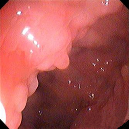潰瘍性結腸炎乳頭狀