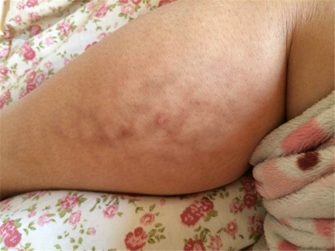 孕婦腿部靜脈炎