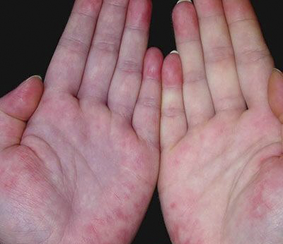 系統性紅斑狼瘡診斷標準 (43) 