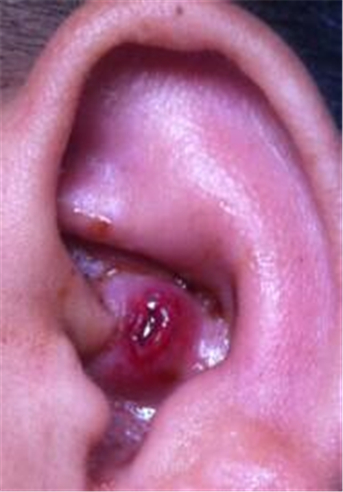 幼兒侷限性外耳道炎