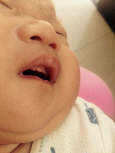 寶寶鵝口瘡 (61) 