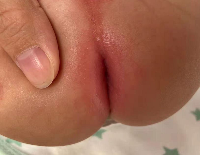 寶寶紅屁屁照片 (8) 