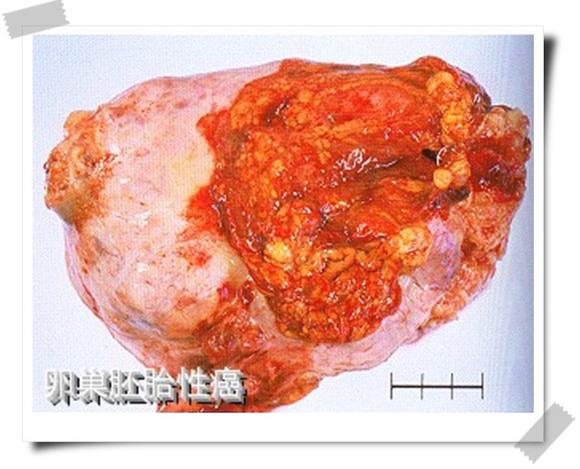 胚胎性卵巢癌標本