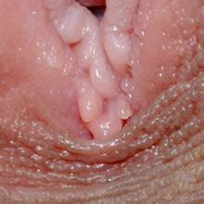 黴菌陰炎症狀 (6) 