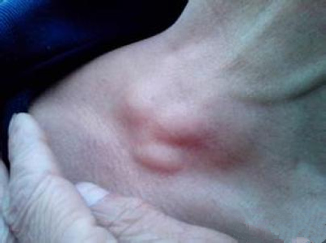 鎖骨的淋巴結核