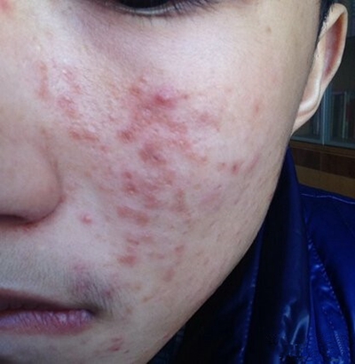 激素臉排毒症狀 (55) 