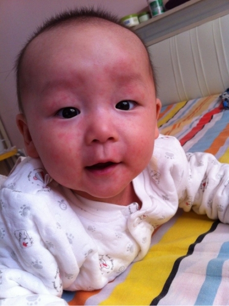 小兒急疹的症狀 (5) 