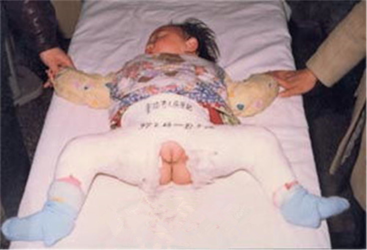 蛙式治療尿道下裂