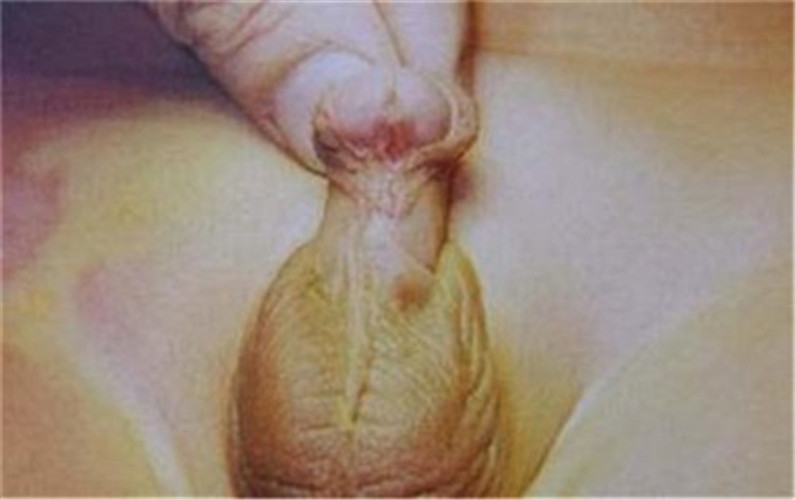 尿道下裂病患檢查