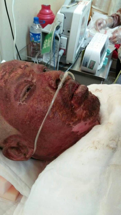 深二度燒傷 (48) 