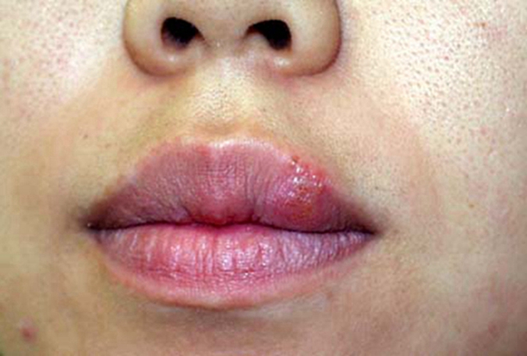 口唇皰疹留疤