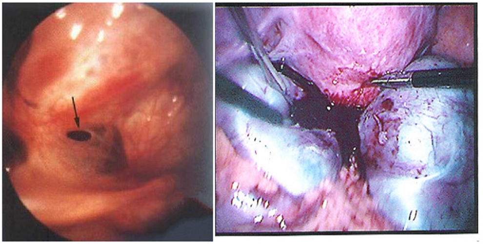 什麼是巧克力囊腫