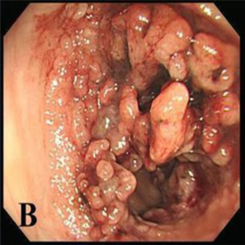 直腸息肉黑斑的