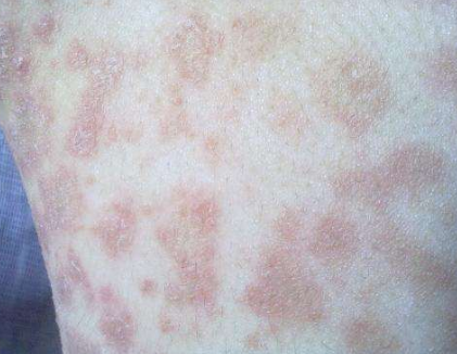 皮膚澱粉樣變 (59) 