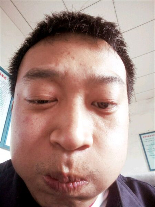 中年男子面癱的