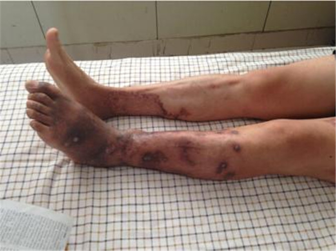 慢性骨髓炎腿部