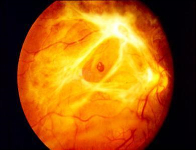 糖尿病人視網膜脫落